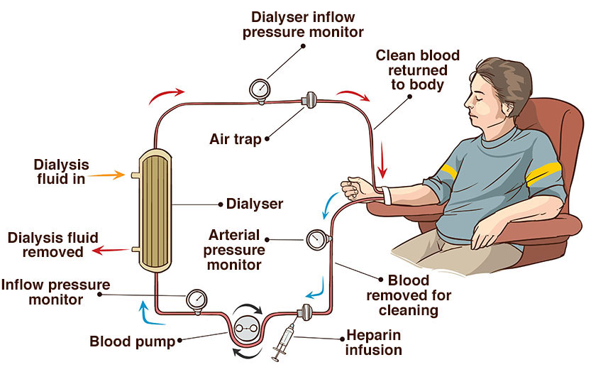 haemodialysis